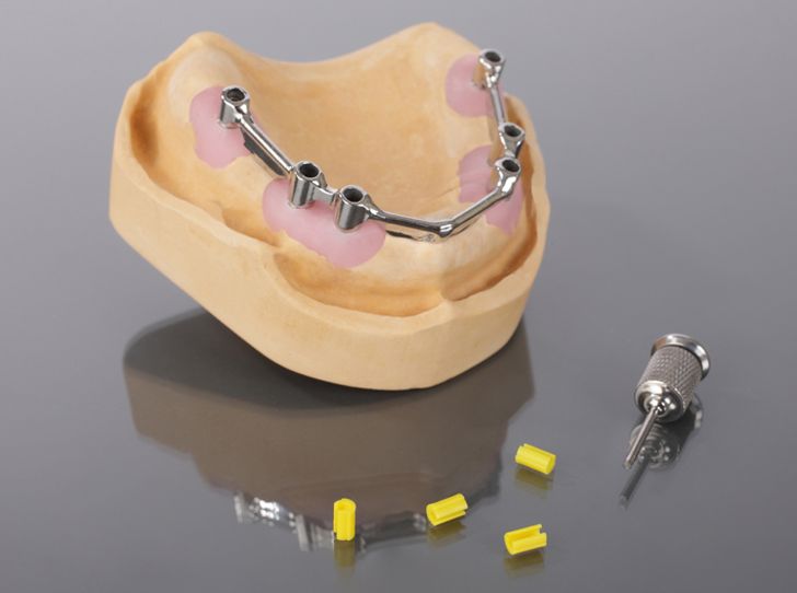 how to get free dental implants
