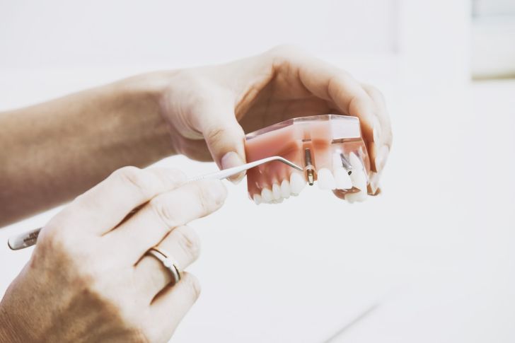 mini-dental-implant