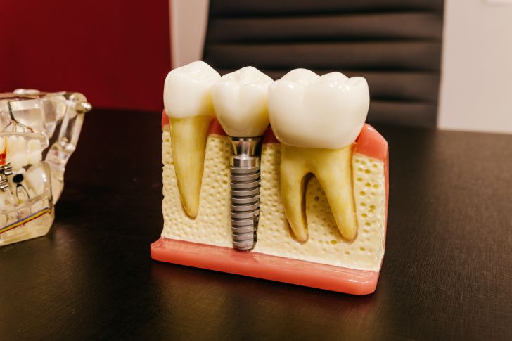 are-there-government-grants-for-dental-implants